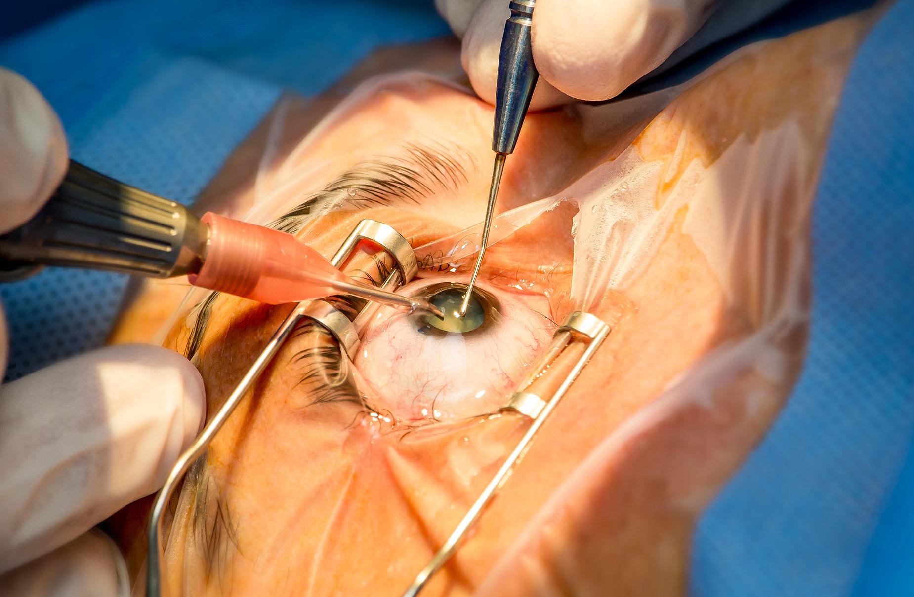 Chirurgie de la Cataracte