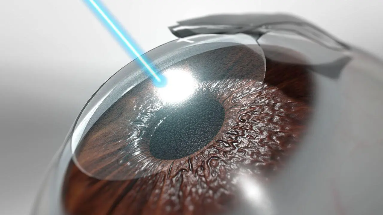 Chirurgie LASIK