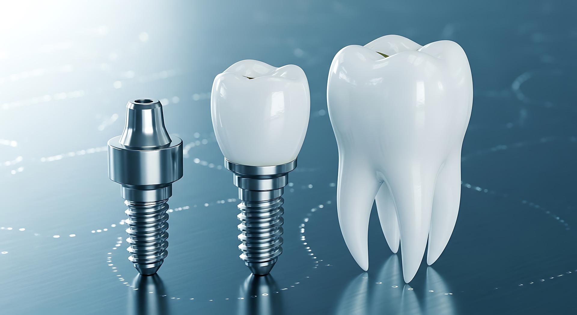 Implant Dentaire