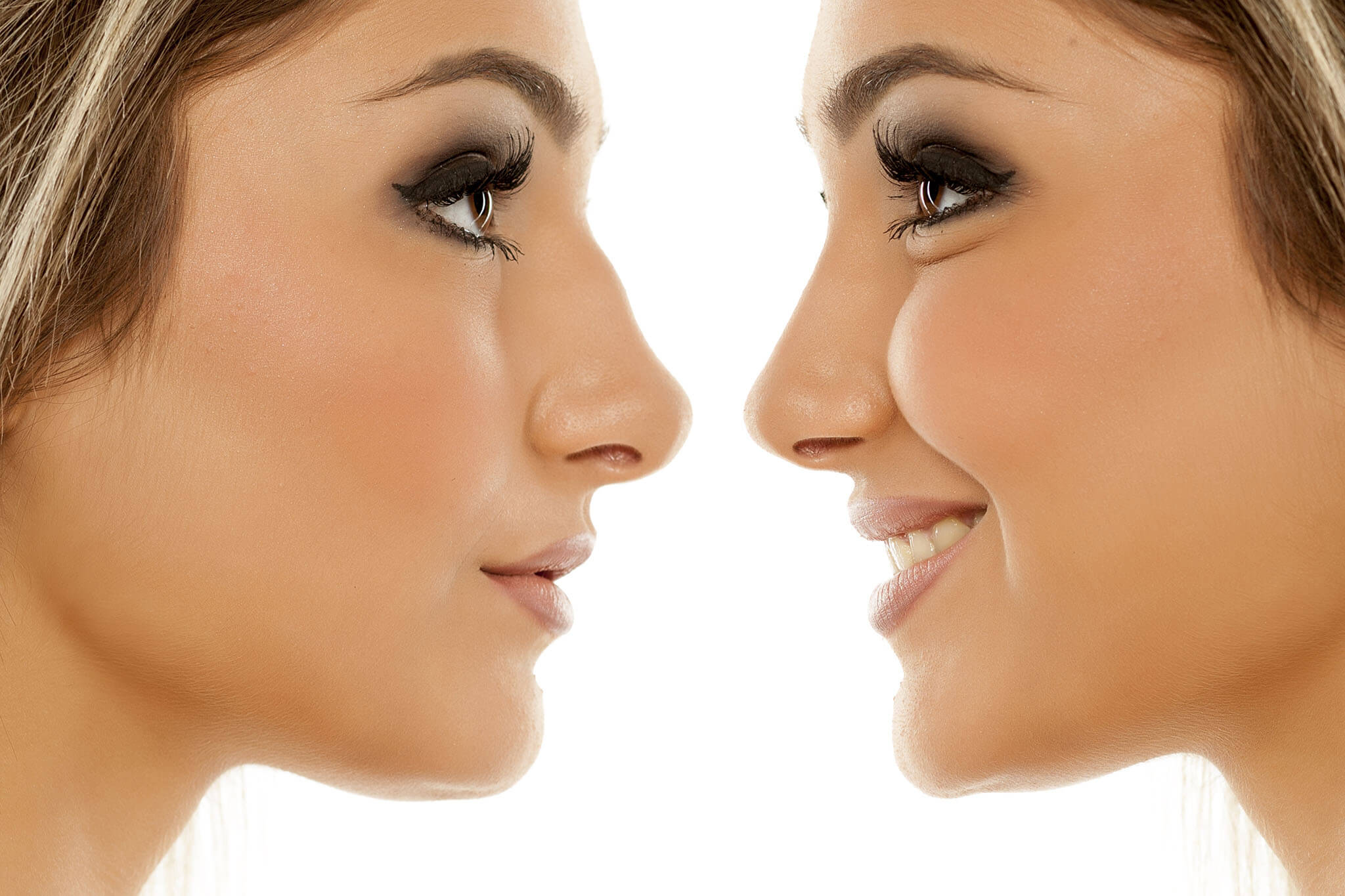 Rhinoplastie
